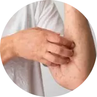pengobatan eksim