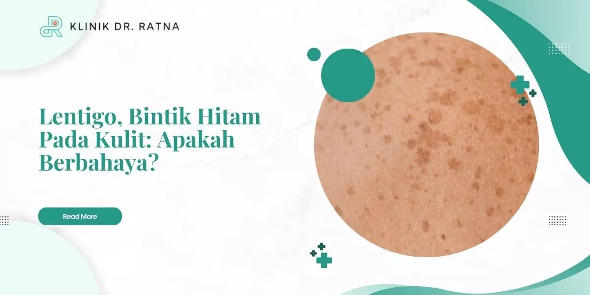 Lentigo, Bintik Hitam Pada Kulit: Apakah Berbahaya?