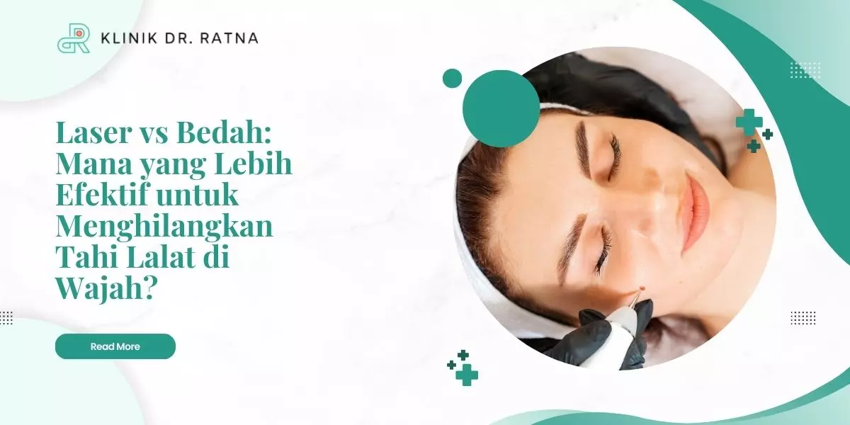 Laser vs Bedah: Mana yang Lebih Efektif untuk Menghilangkan Tahi Lalat di Wajah?