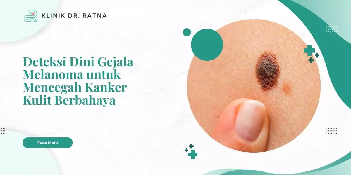 Deteksi Dini Gejala Melanoma untuk Mencegah Kanker Kulit Berbahaya