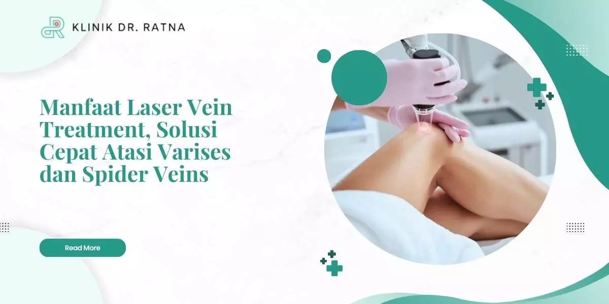 Manfaat Laser Vein Treatment, Solusi Cepat Atasi Varises dan Spider Veins
