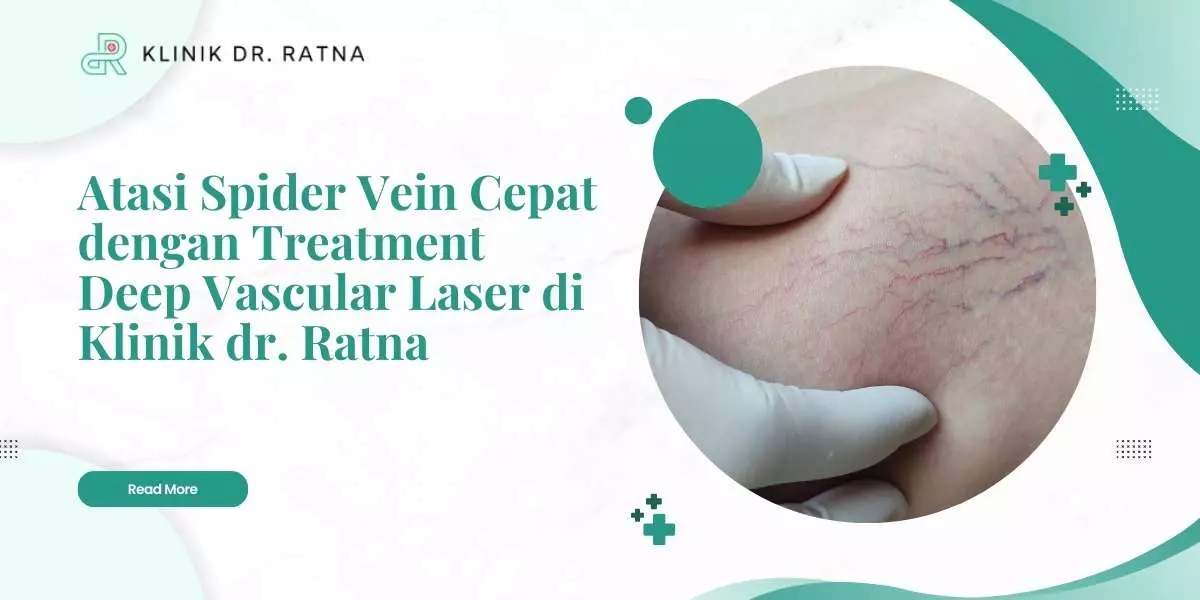 Atasi Spider Vein Cepat dengan Treatment Deep Vascular Laser di Klinik dr. Ratna