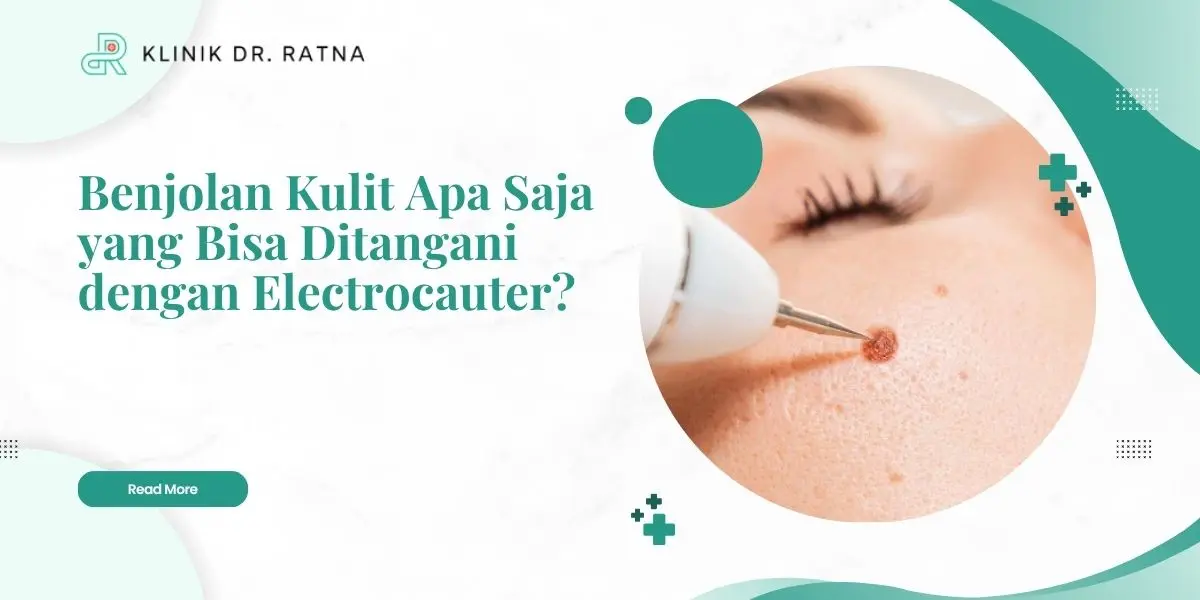 Benjolan Kulit Apa Saja yang Bisa Ditangani dengan Electrocauter?