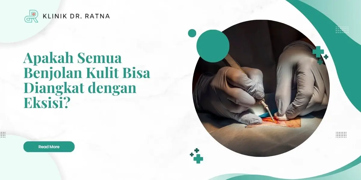 Apakah Semua Benjolan Kulit Bisa Diangkat dengan Eksisi?