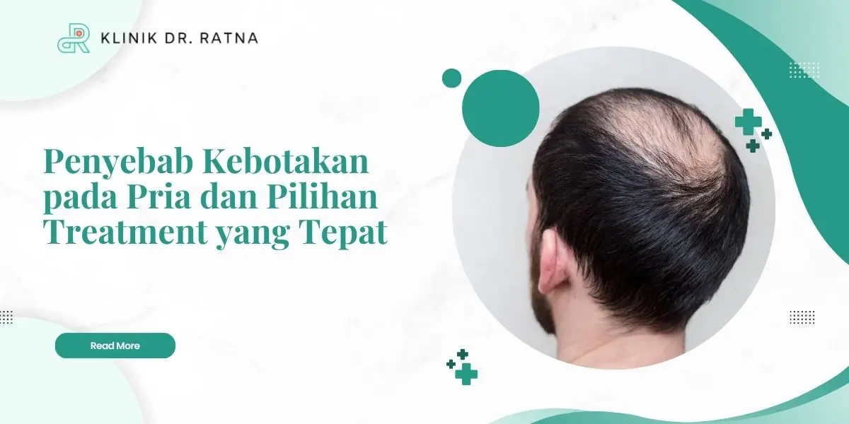 Penyebab Kebotakan pada Pria dan Pilihan Treatment yang Tepat