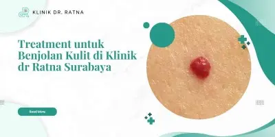 Treatment untuk Benjolan Kulit di Klinik dr Ratna Surabaya