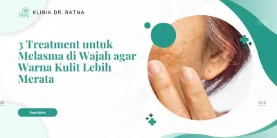 3 Treatment untuk Melasma di Wajah agar Warna Kulit Lebih Merata