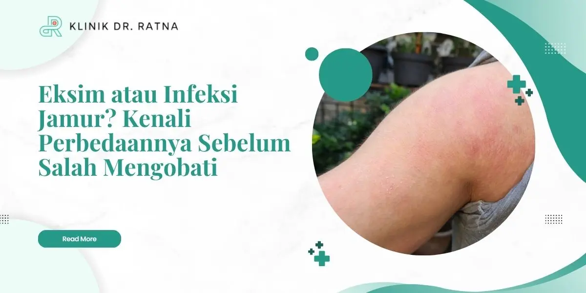 Eksim atau Infeksi Jamur? Kenali Perbedaannya Sebelum Salah Mengobati