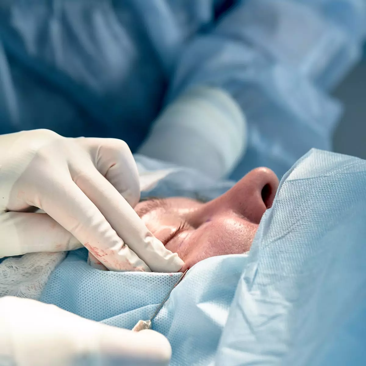 Jenis-jenis Double Eyelid Surgery