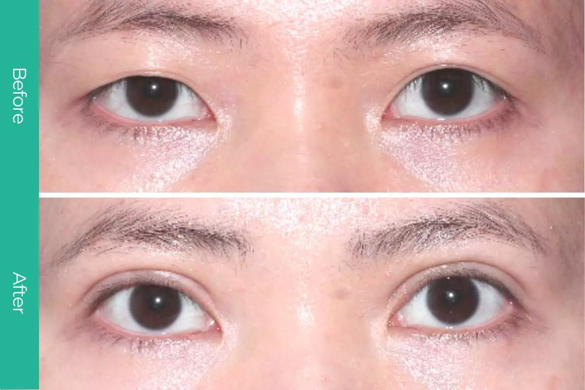 Eyelid Surgery 10 