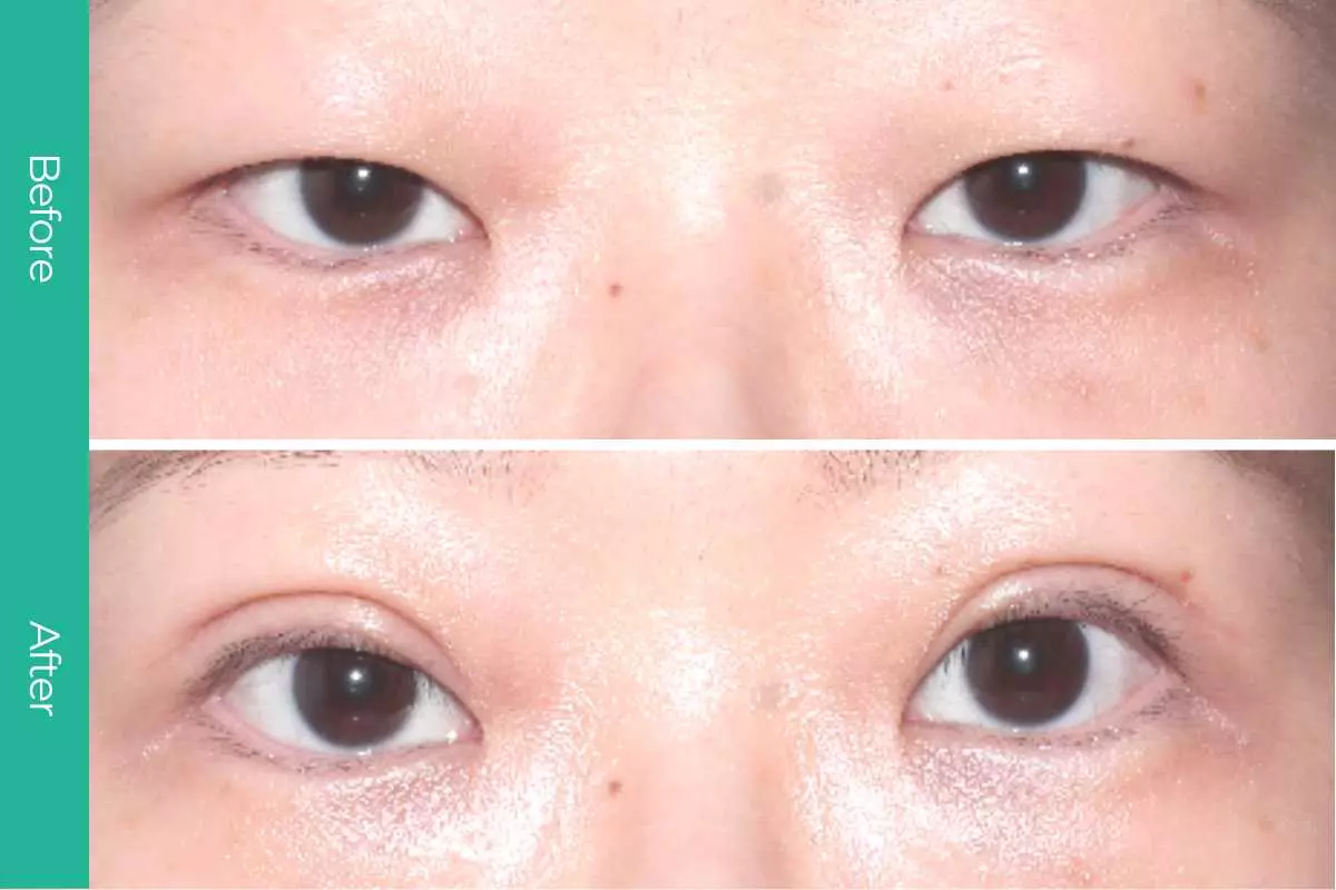Eyelid Surgery 11 