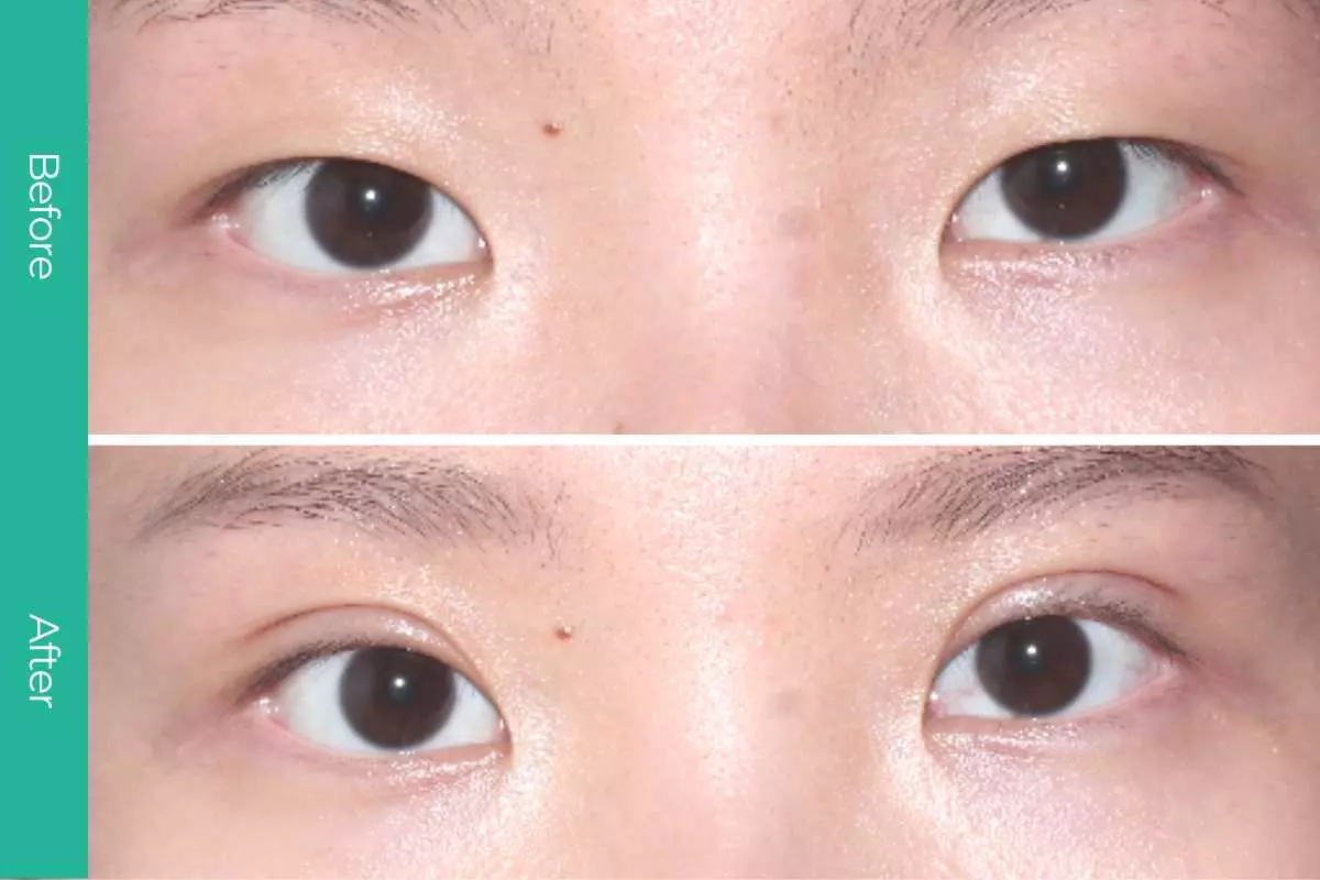 Eyelid Surgery 12 