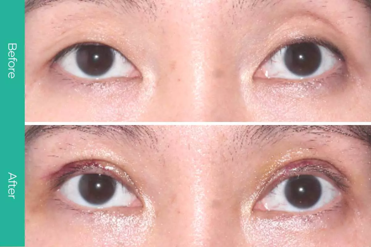 Eyelid Surgery 13 