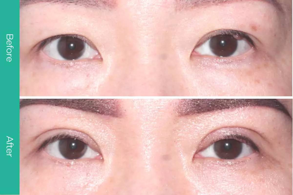 Eyelid Surgery 14 