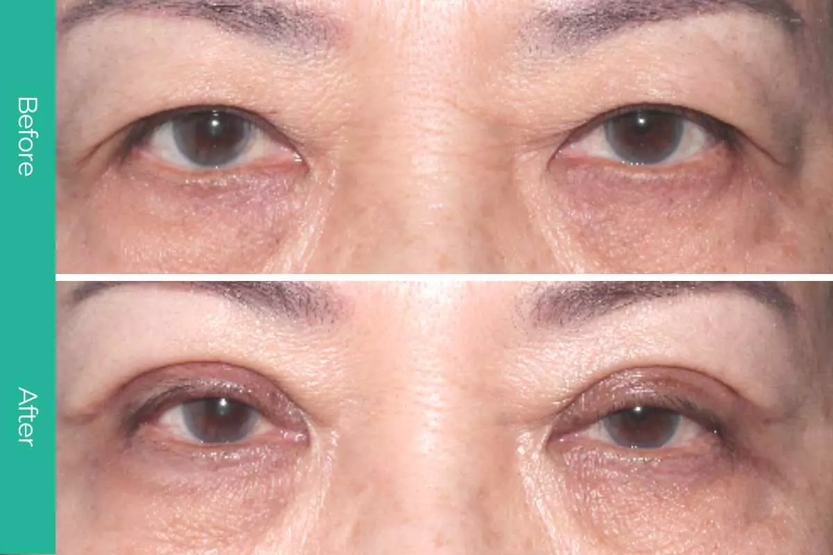 Eyelid Surgery 15 