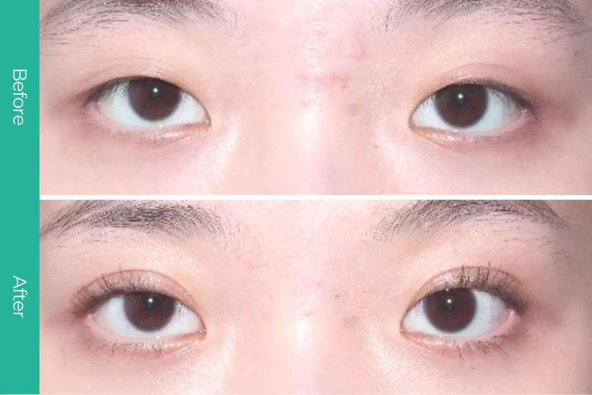 Eyelid Surgery 16 