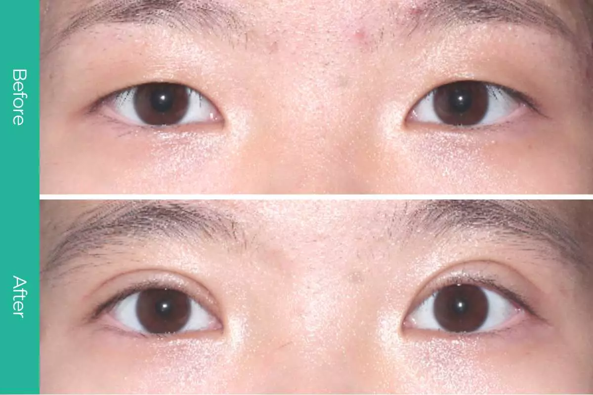 Eyelid Surgery 17 