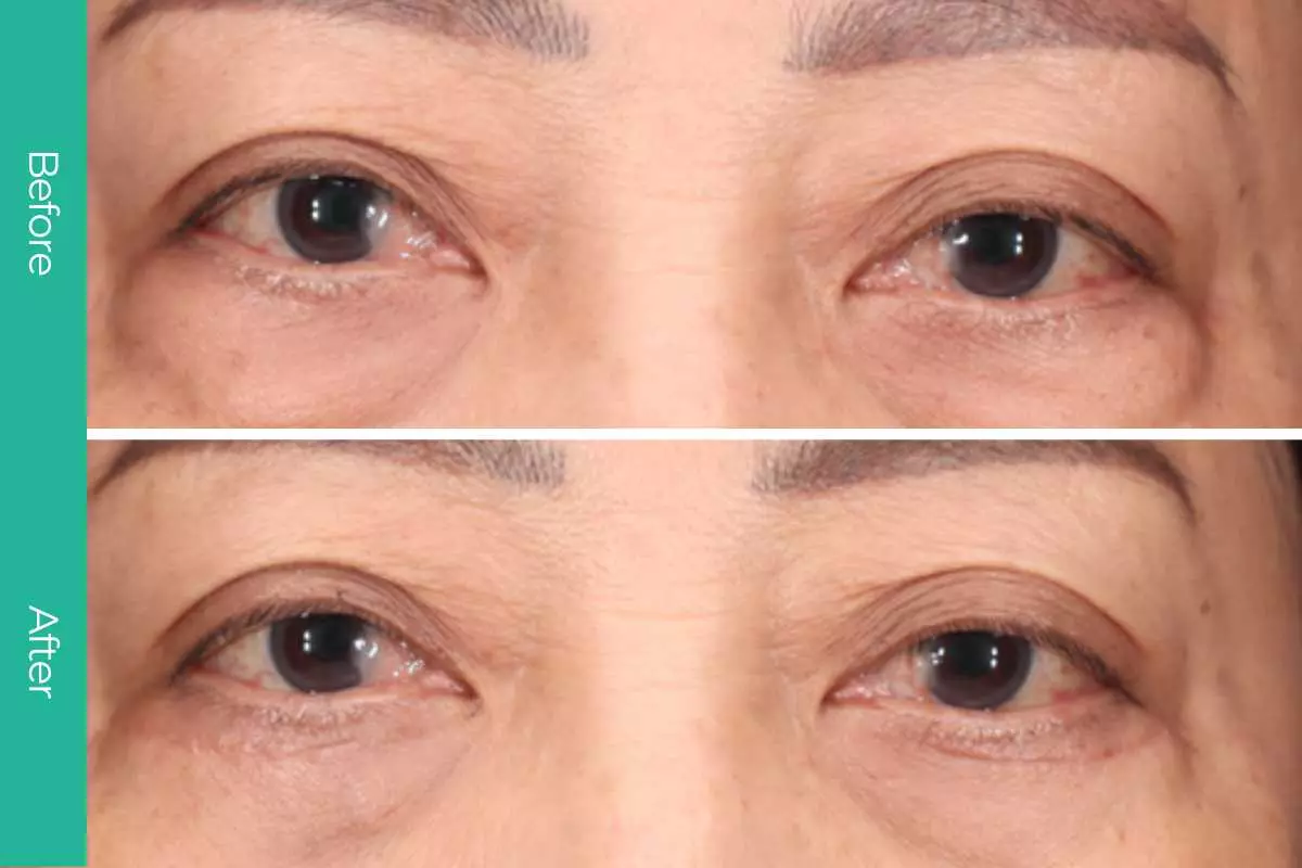 Eyelid Surgery 2 