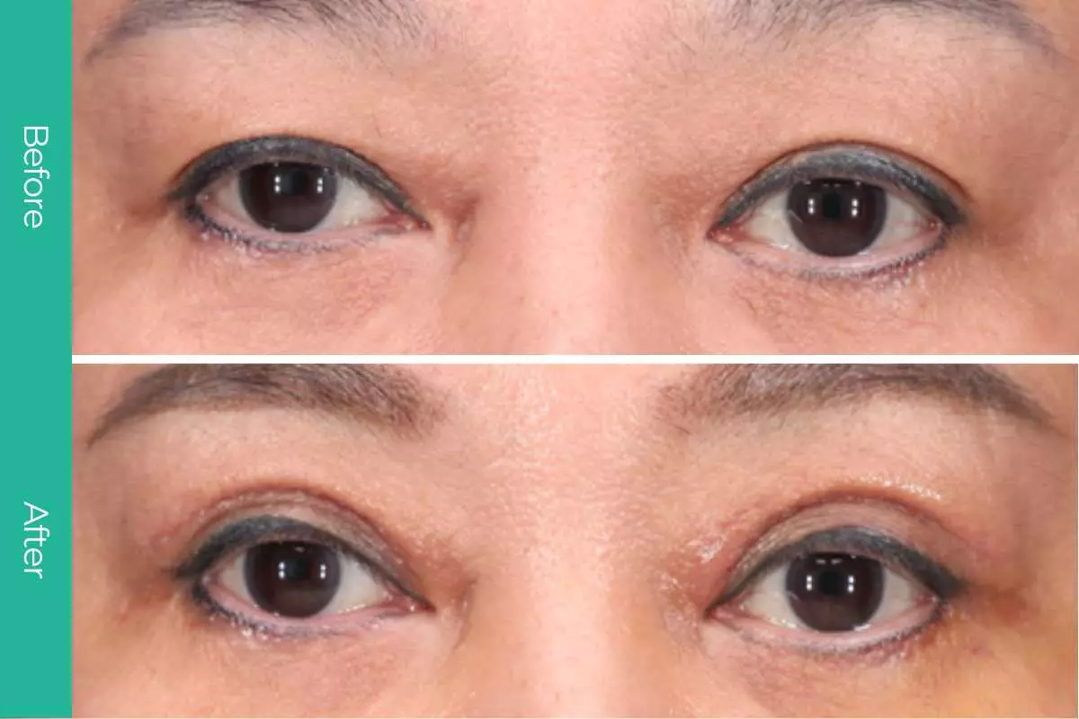 Eyelid Surgery 3 