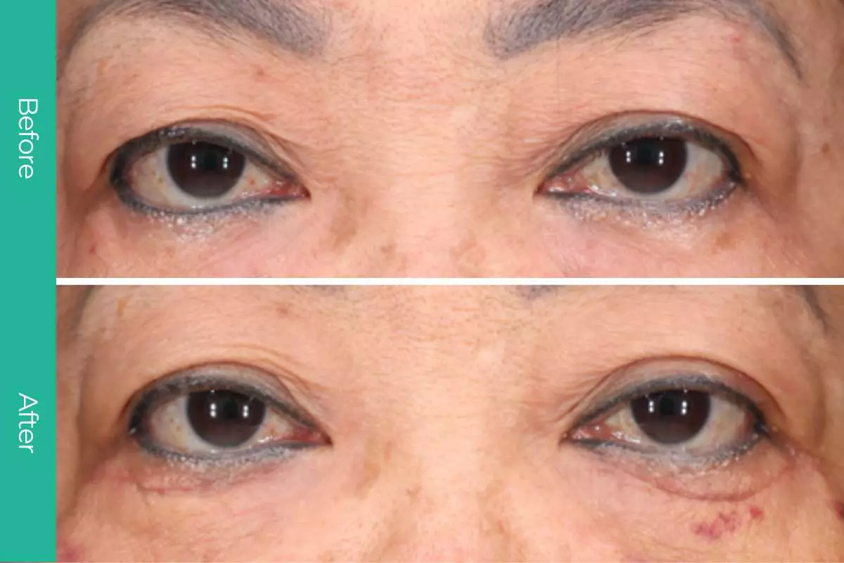 Eyelid Surgery 4 