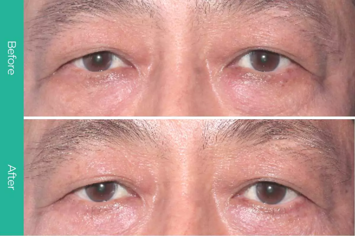 Eyelid Surgery 5 