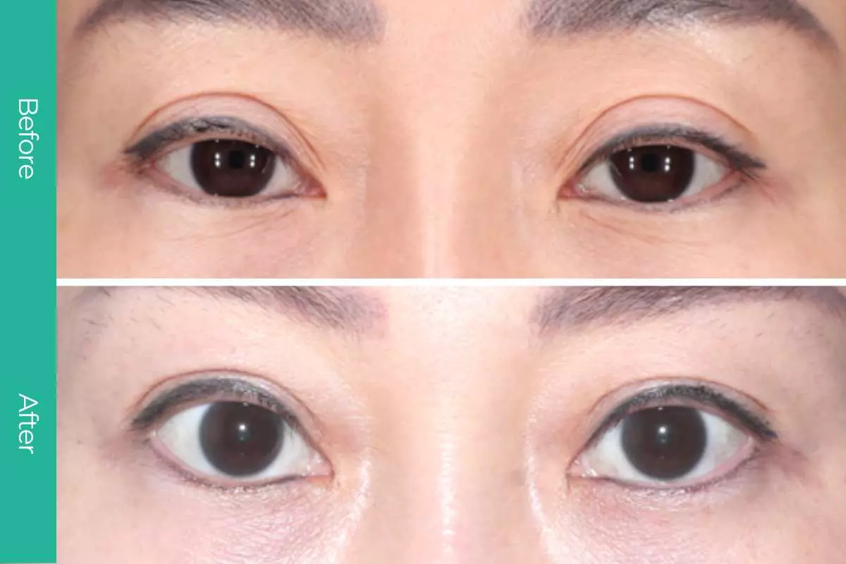 Eyelid Surgery 6 
