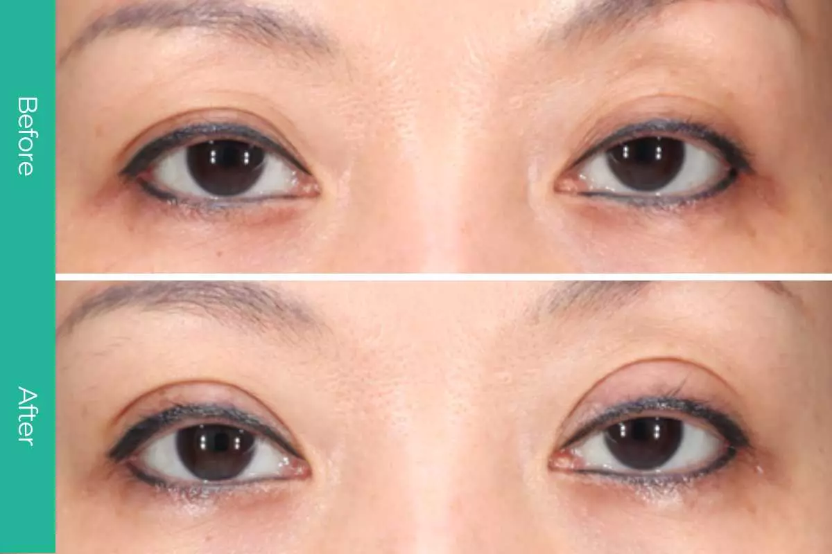 Eyelid Surgery 7 