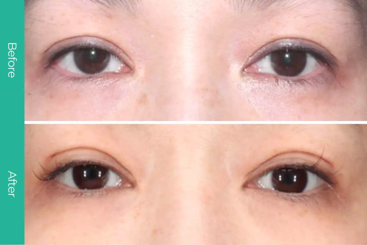 Eyelid Surgery 8 