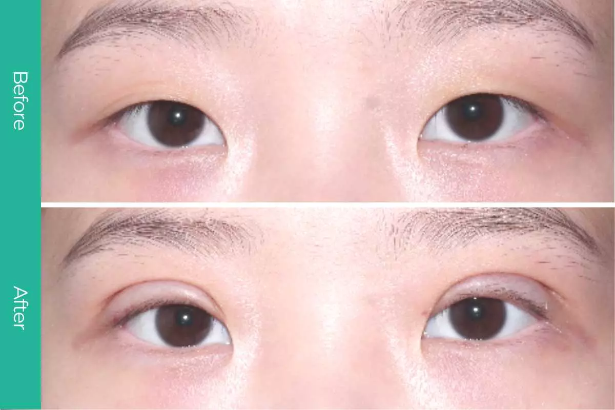 Eyelid Surgery 9 