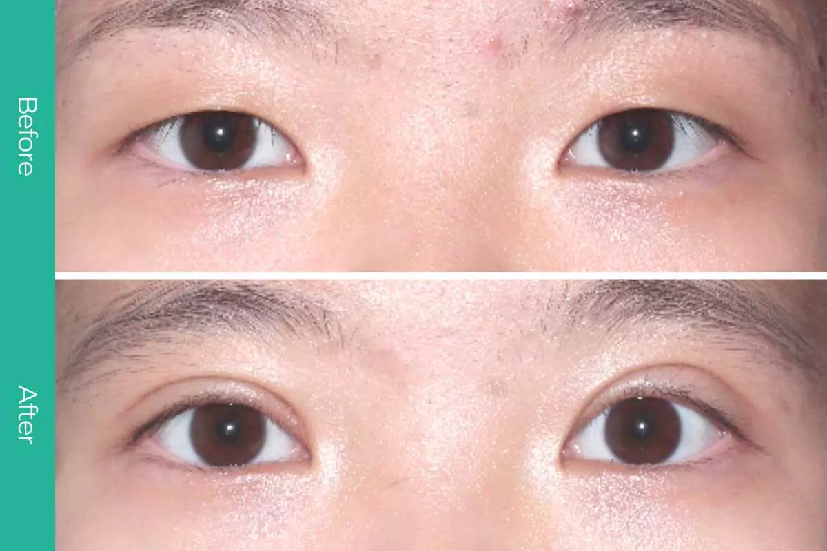 Eyelid Surgery