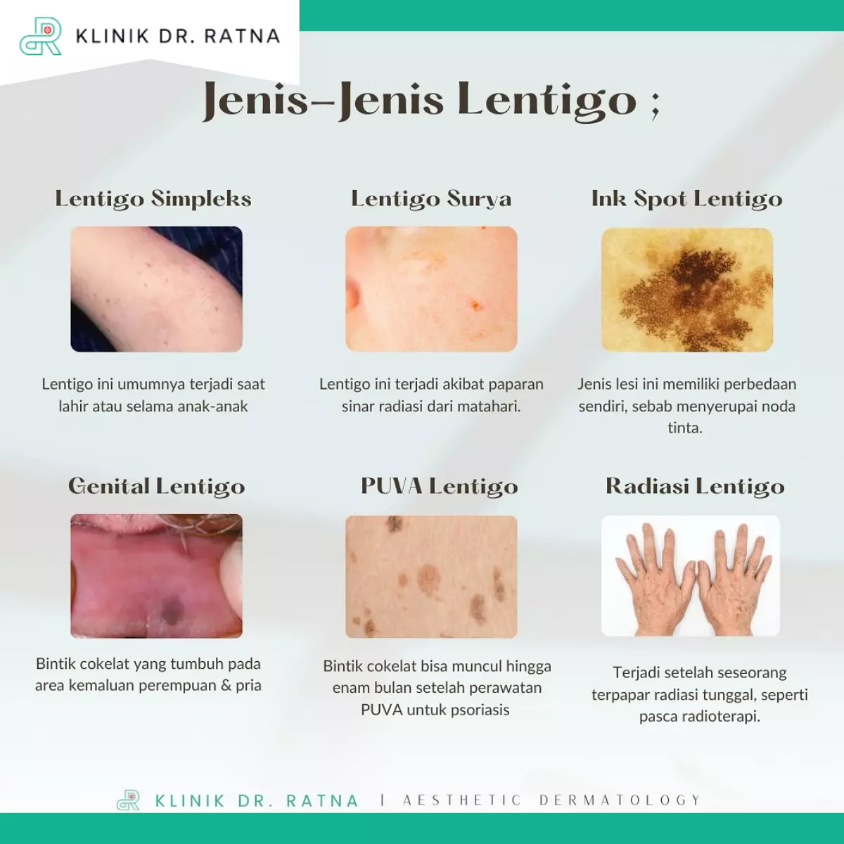 Jenis-Jenis Lentigo