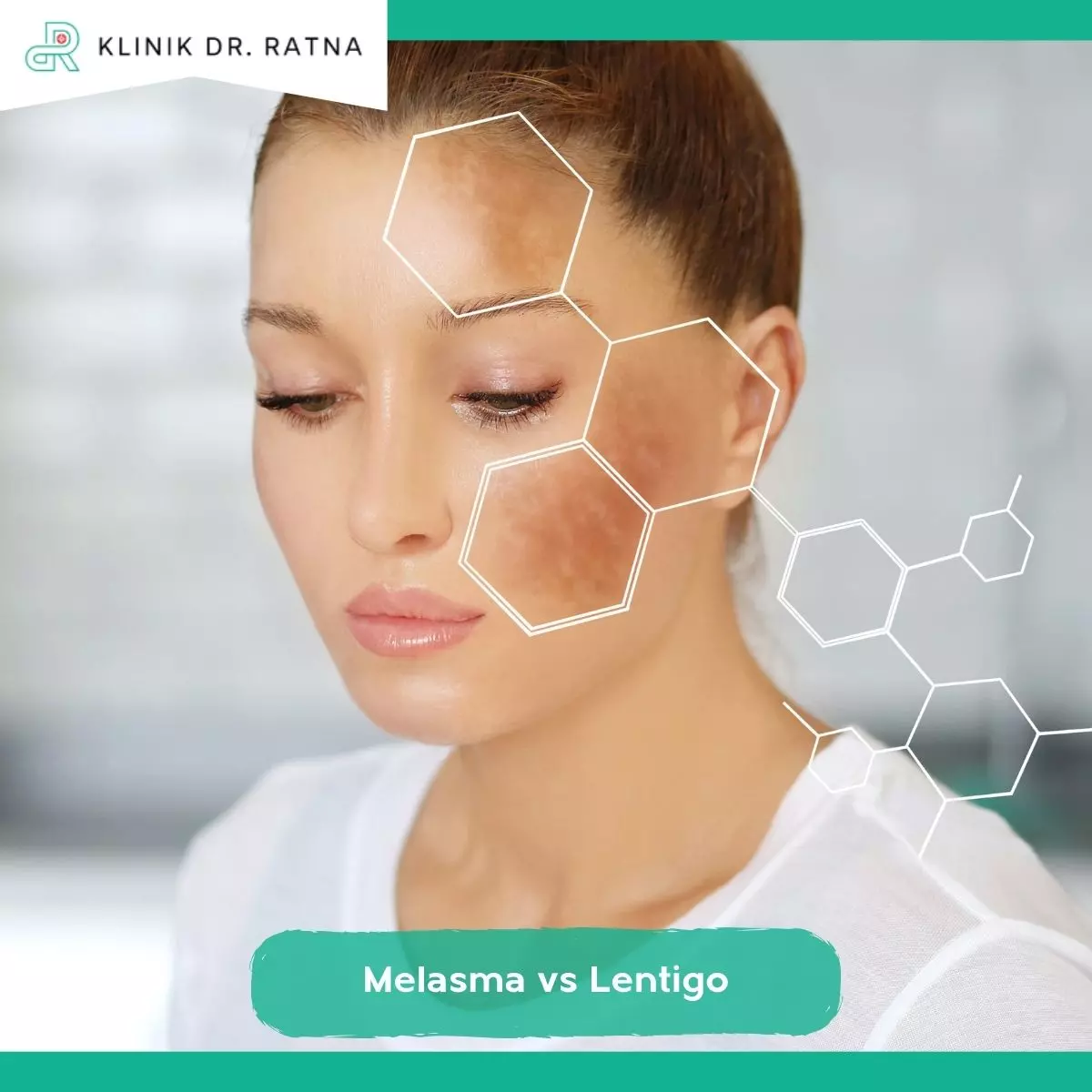 Lentigo vs Melasma: Apa Bedanya?