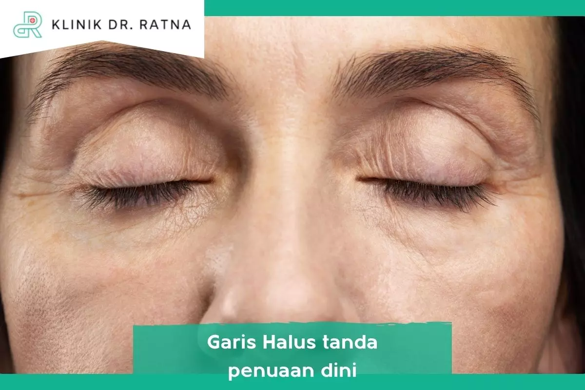 2. Garis Halus di Sekitar Mata