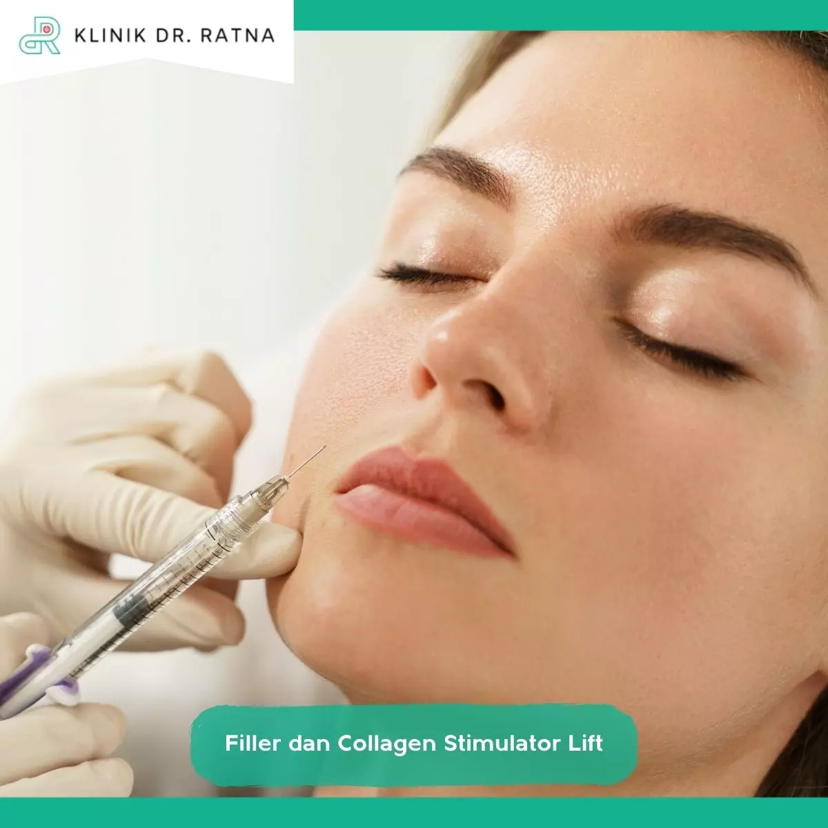 1. Apa Itu Filler dan Collagen Stimulator Lift?