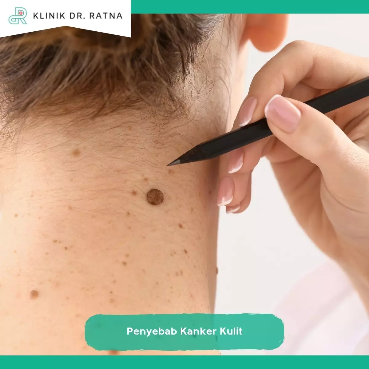 Penyebab Kanker Kulit
