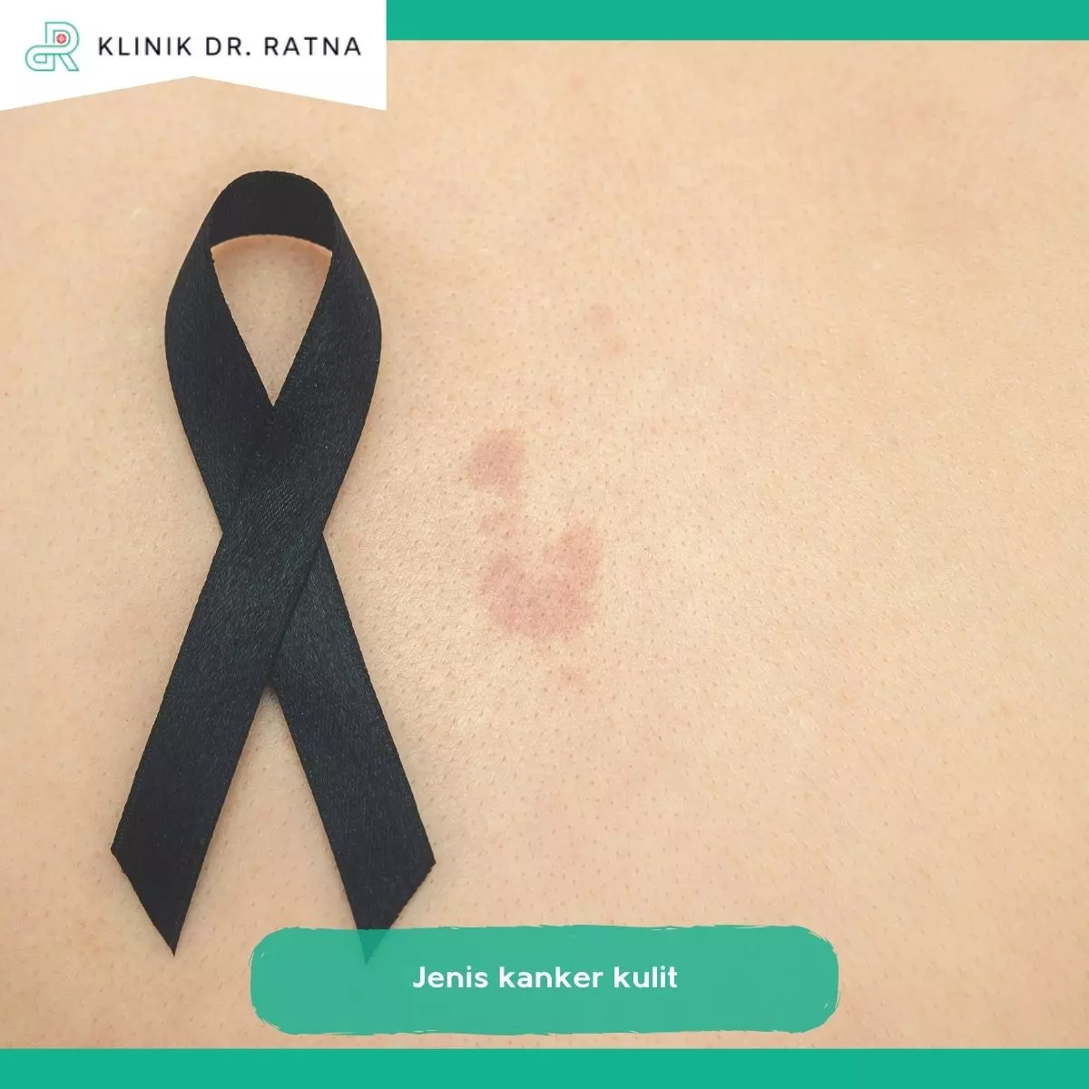 Jenis-Jenis Kanker Kulit