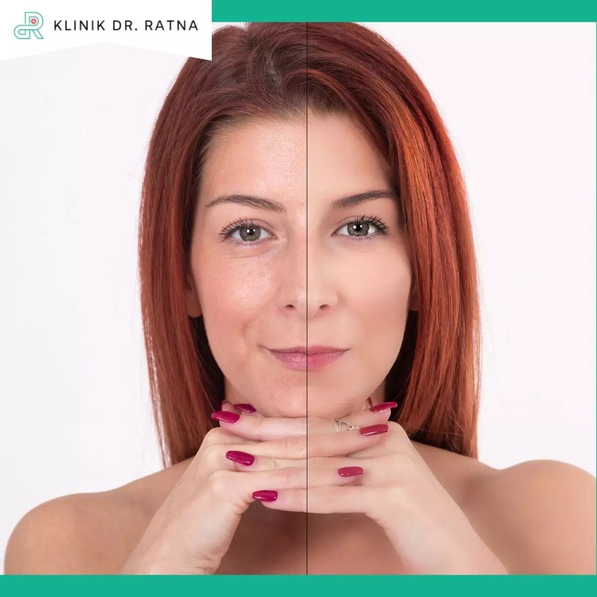 Kulit Lebih Kencang dan Glowing dengan Collagen Stimulator Lift Treatment di Klinik dr Ratna