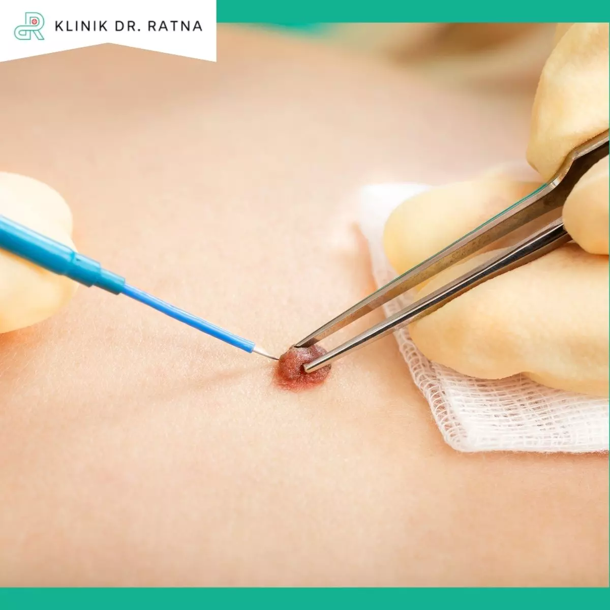 1. Pengangkatan Tahi Lalat (Eksisi Nevus)