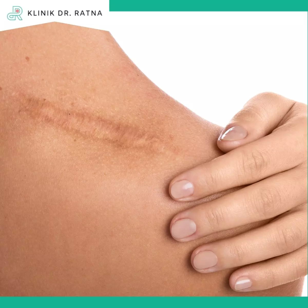 5. Scar Revision (Perbaikan Bekas Luka)