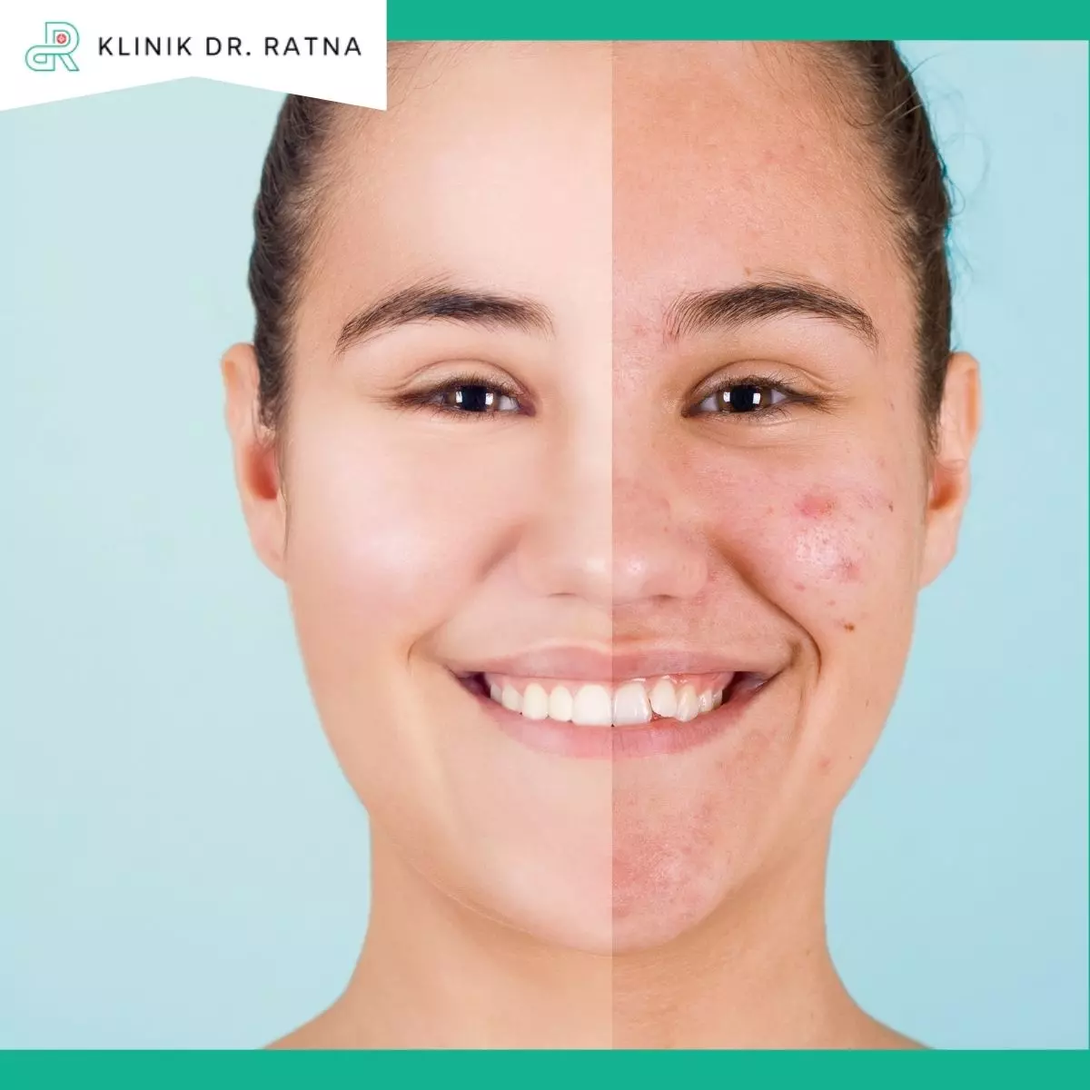 Manfaat Anti-Acne Booster Treatment