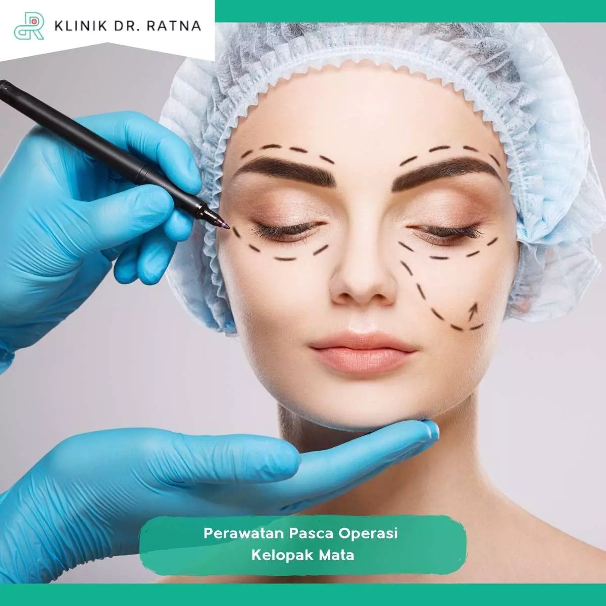Operasi Kelopak Mata (Blepharoplasty)
