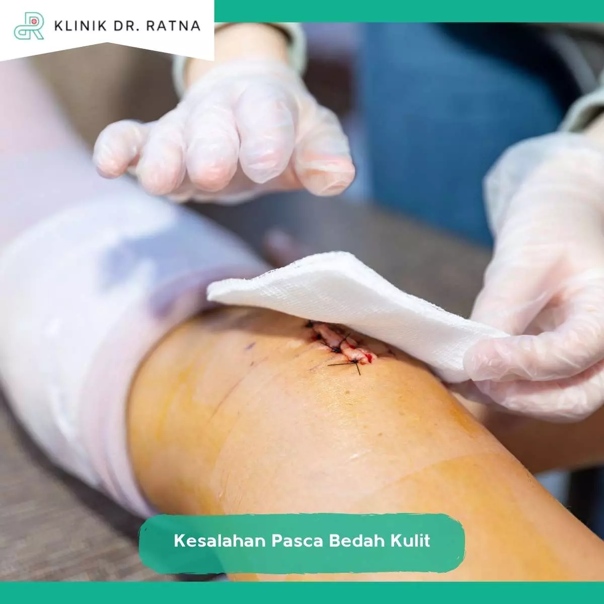 Pentingnya Perawatan Luka Pasca Operasi Kulit