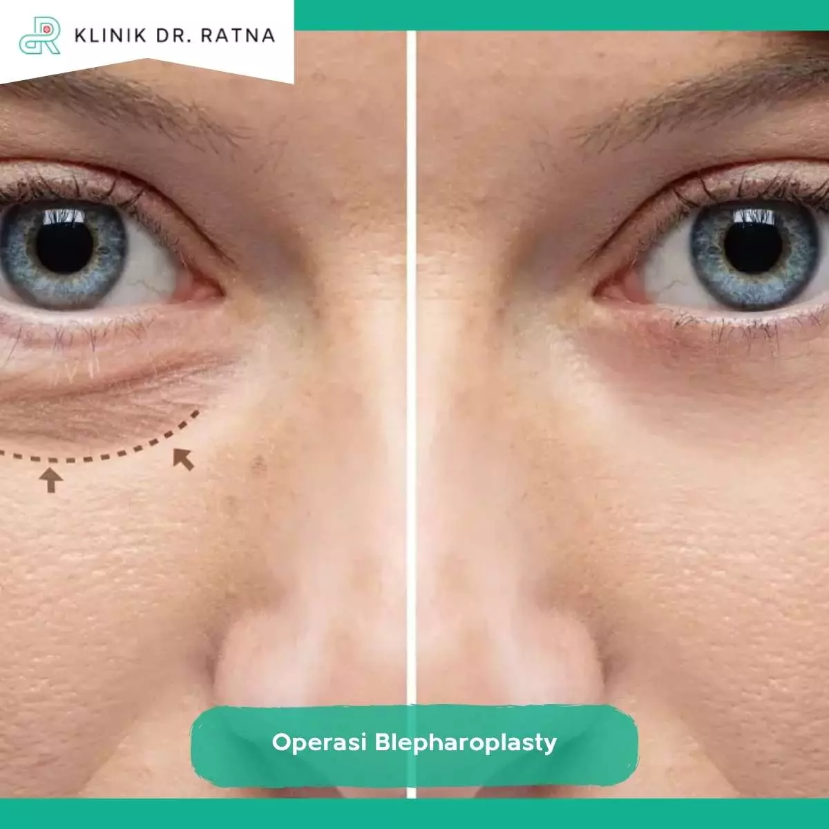 Apa itu Operasi Blepharoplasty?