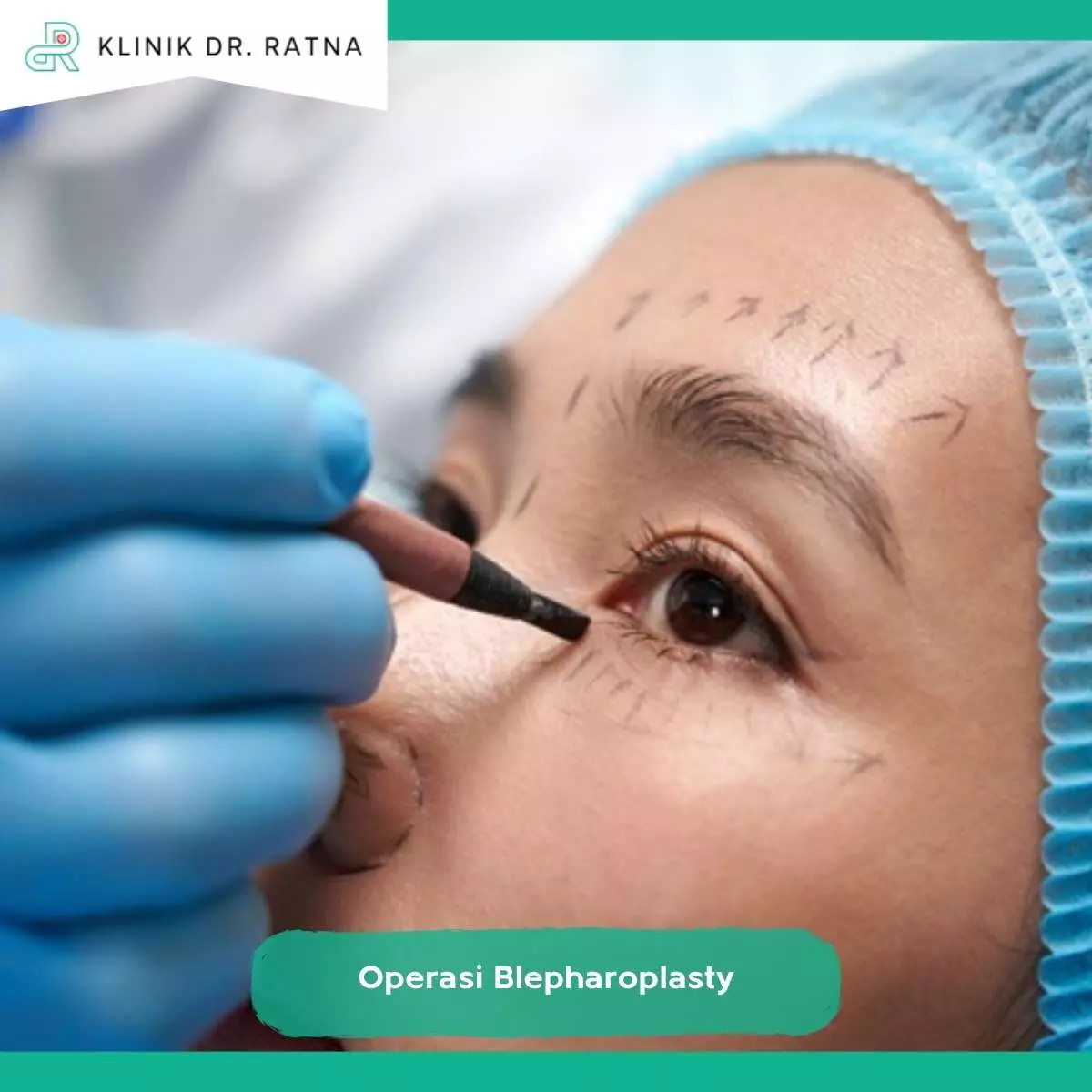 Prosedur Blepharoplasty untuk Kantung Mata