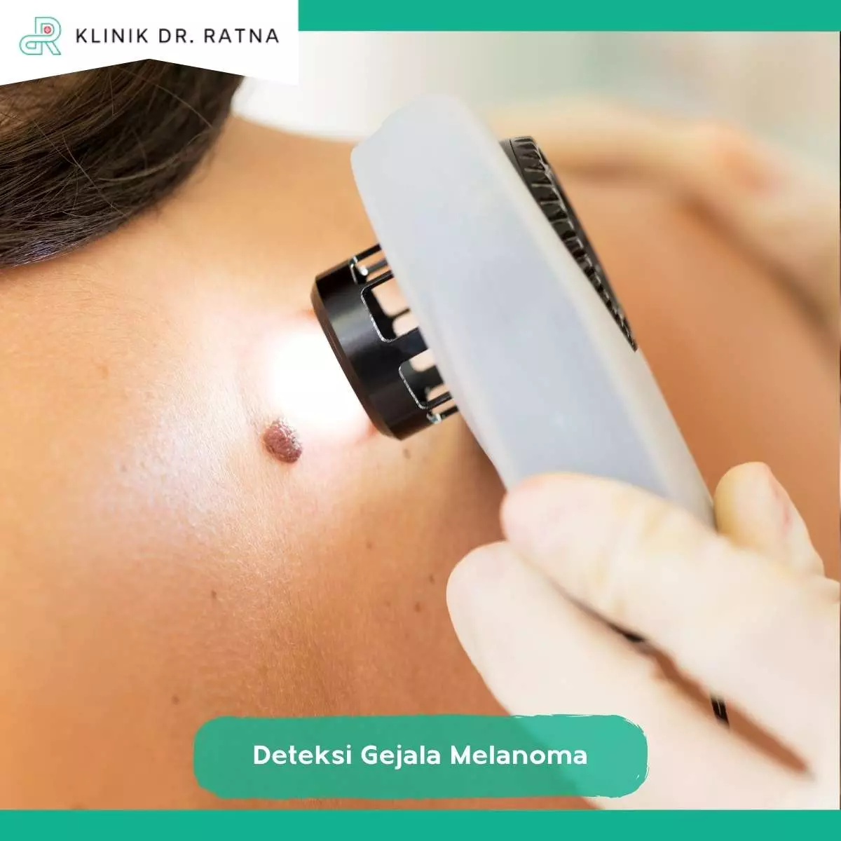 Deteksi Dini Melanoma