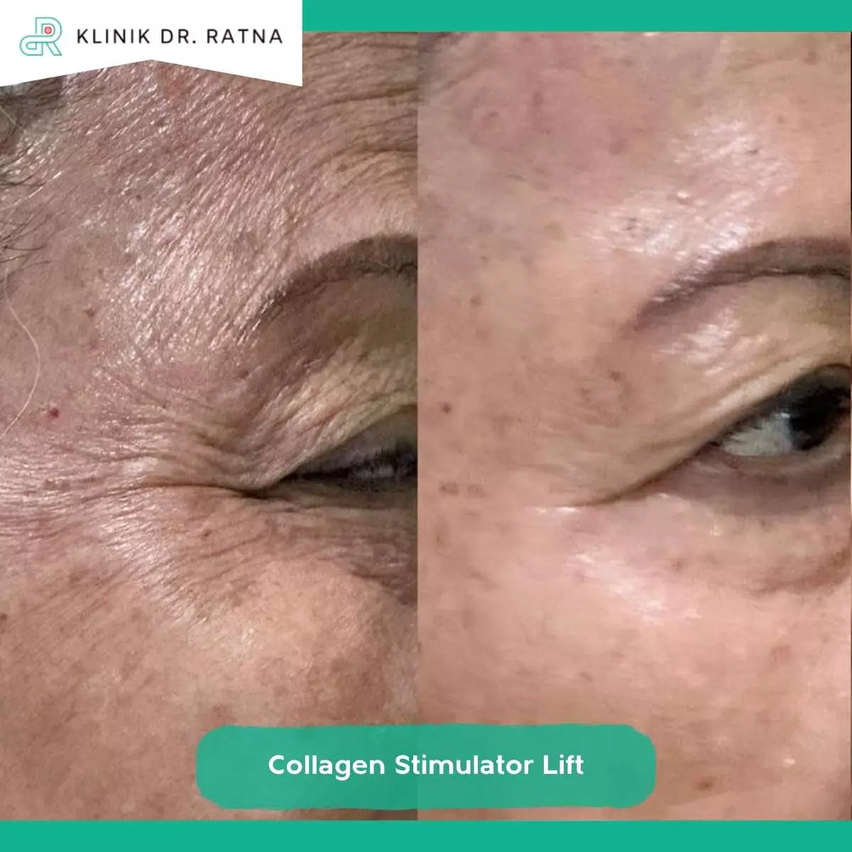 Collagen Stimulator Lift di Klinik Dr Ratna