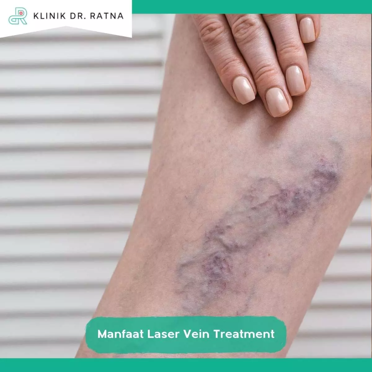 Siapa yang Cocok Menjalani Laser Vein Treatment Varises?