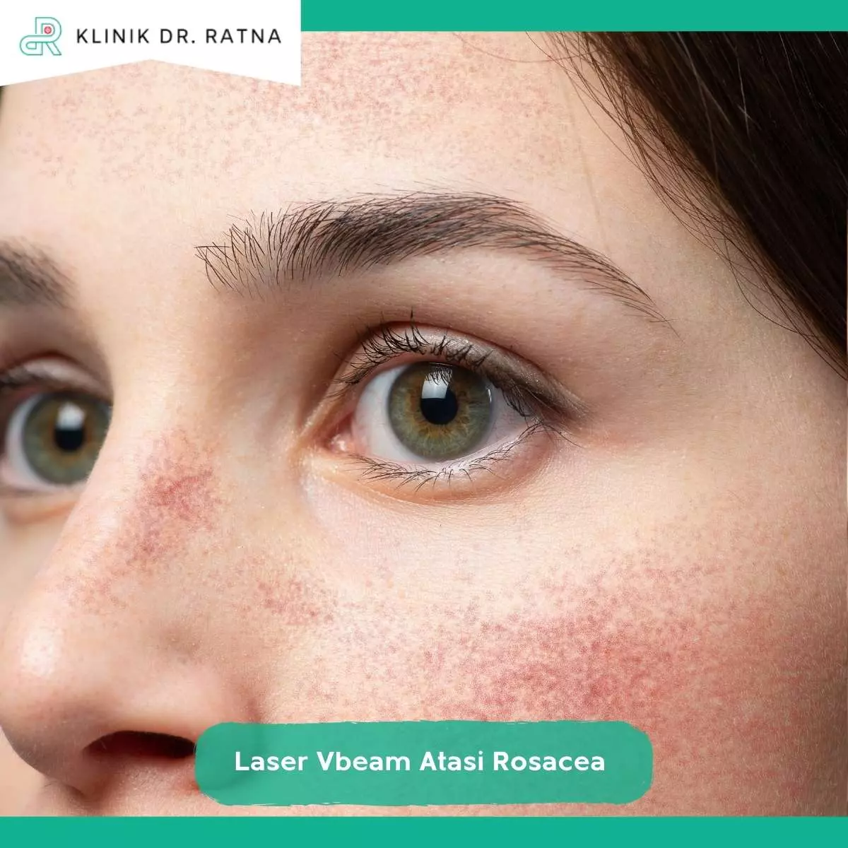 Perawatan Rosacea dengan Laser Vbeam di Klinik Dr Ratna Surabaya