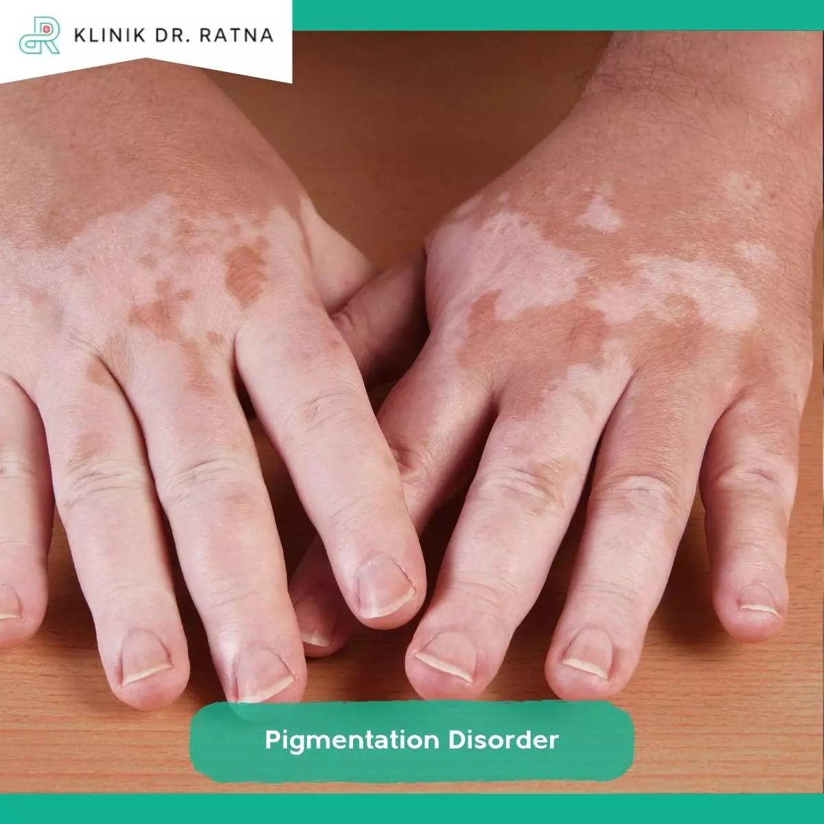 Apa Itu Pigmentation Disorder?