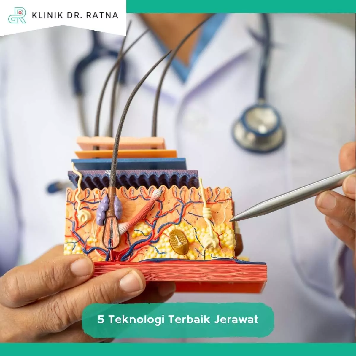 Keunggulan Teknologi Perawatan Jerawat di Klinik dr Ratna